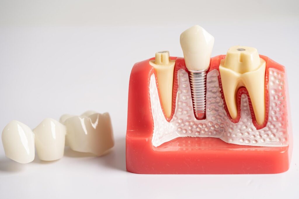 8 Signs That You Need Dental Implants
