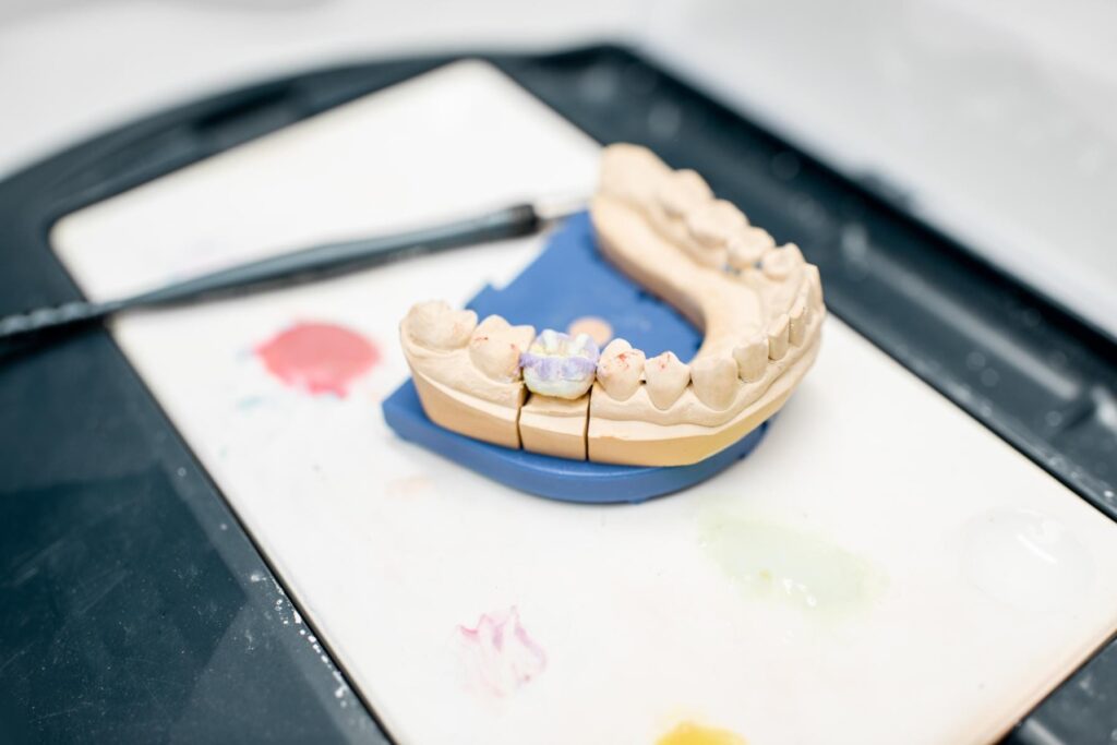 Can You Put A Dental Bridge After A Crown?