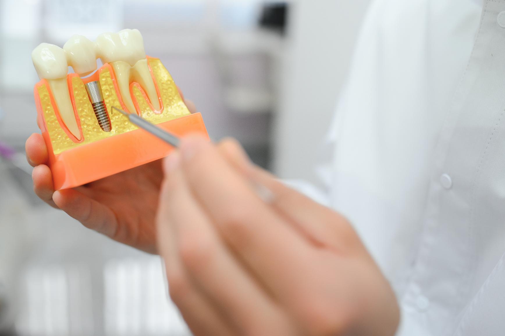 Maximum Time Between Bone Graft And Dental Implant