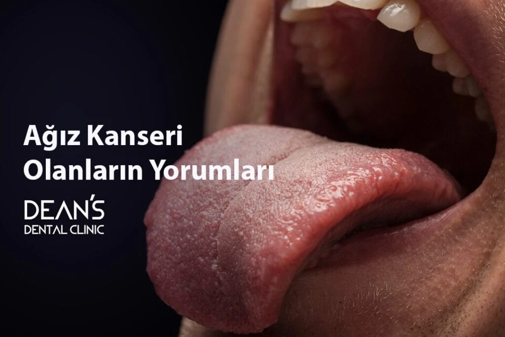 Ağız Kanseri Olanların Yorumları