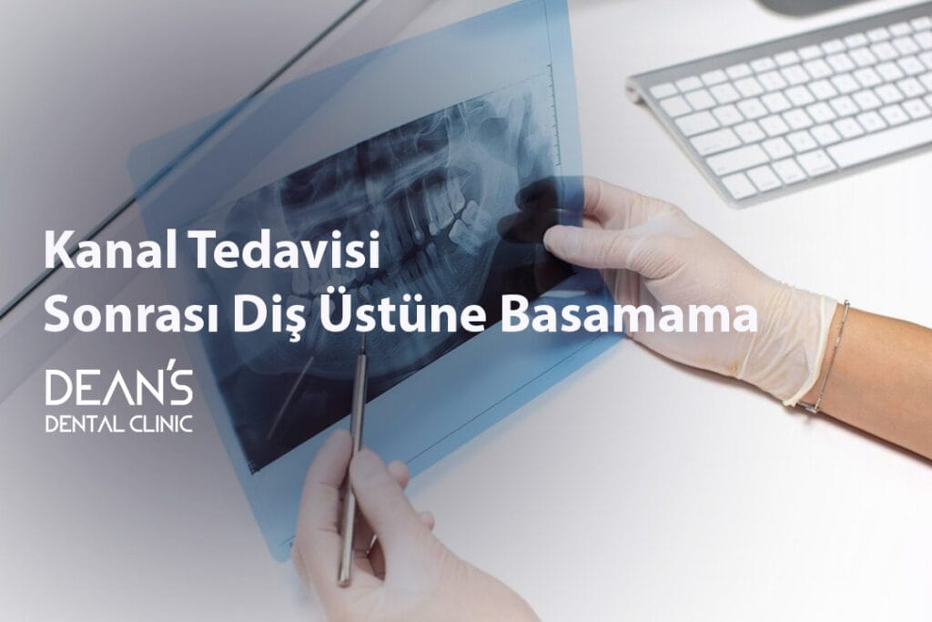 Kanal Tedavisi Sonrası Diş Üstüne Basamama