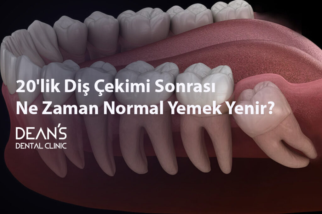 20'lik Diş Çekimi Sonrası Ne Zaman Normal Yemek Yenir