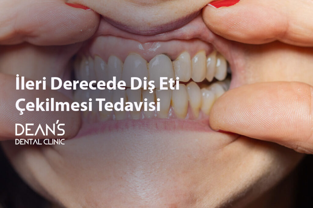 İleri Derecede Diş Eti Çekilmesi Tedavisi