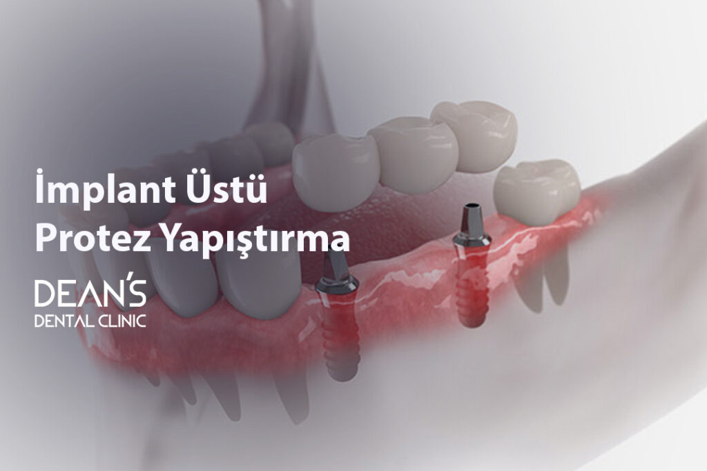 İmplant Üstü Protez Yapıştırma