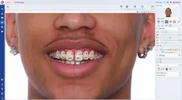 smile design