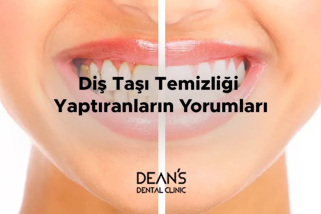 Diş Taşı Temizliği Yaptıranların Yorumları