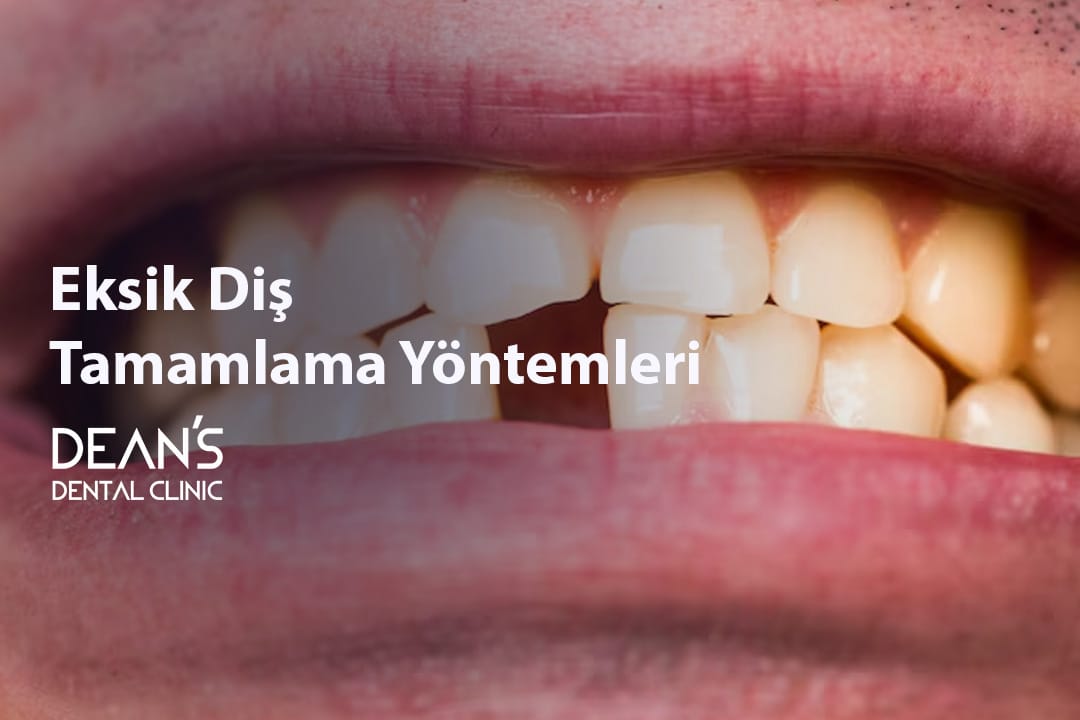 Eksik Diş Tamamlama Yöntemleri – girildi