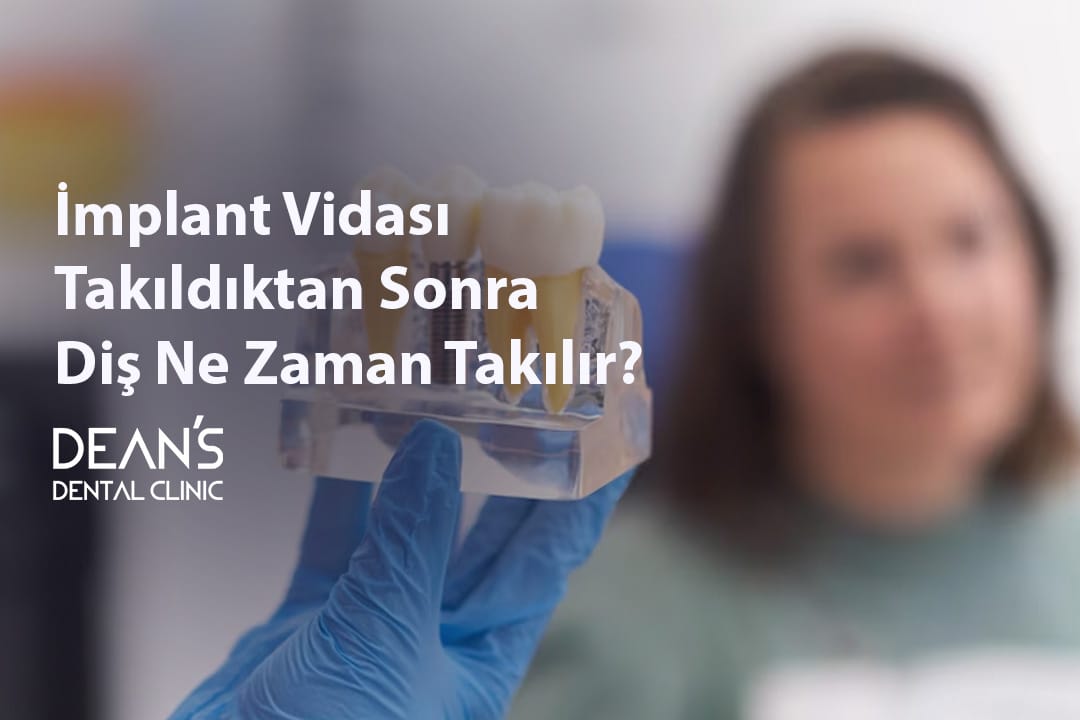 İmplant Vidası Takıldıktan Sonra Diş Ne Zaman Takılır?