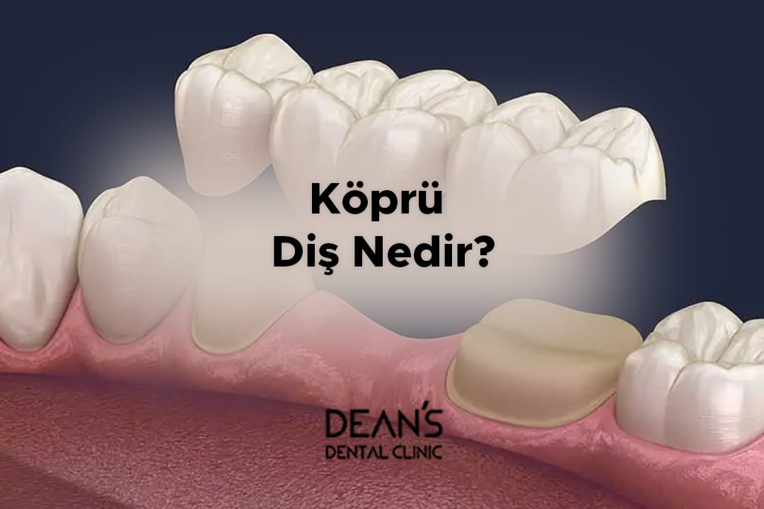 Köprü Diş Nedir?