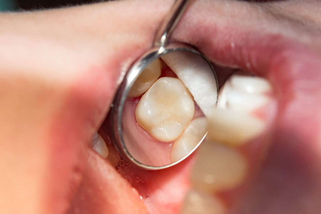 Cavity Filled Cost