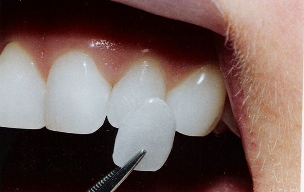 Lumineers Teeth