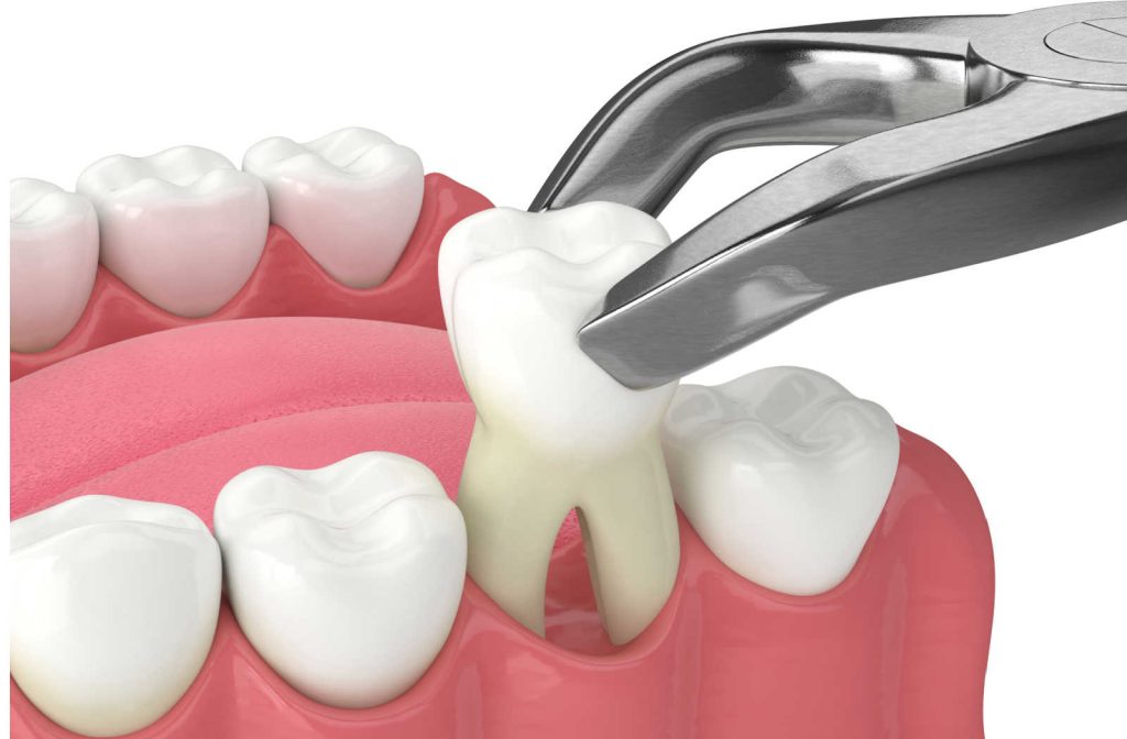 Teeth Extraction Charges