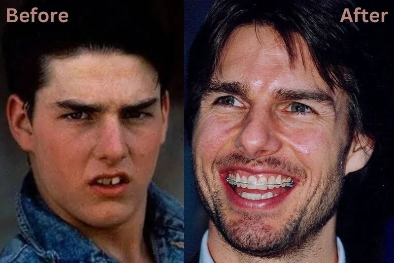 Tom Cruise Teeth