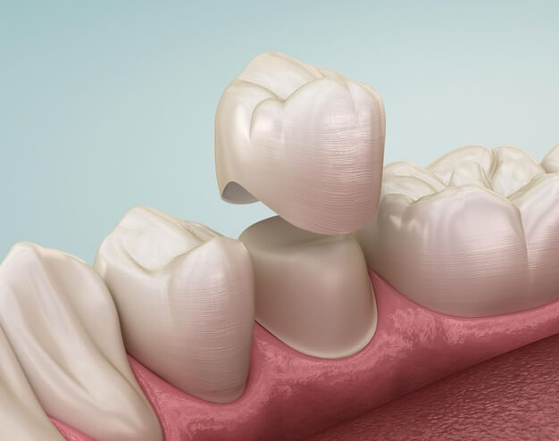 dental crown treatment