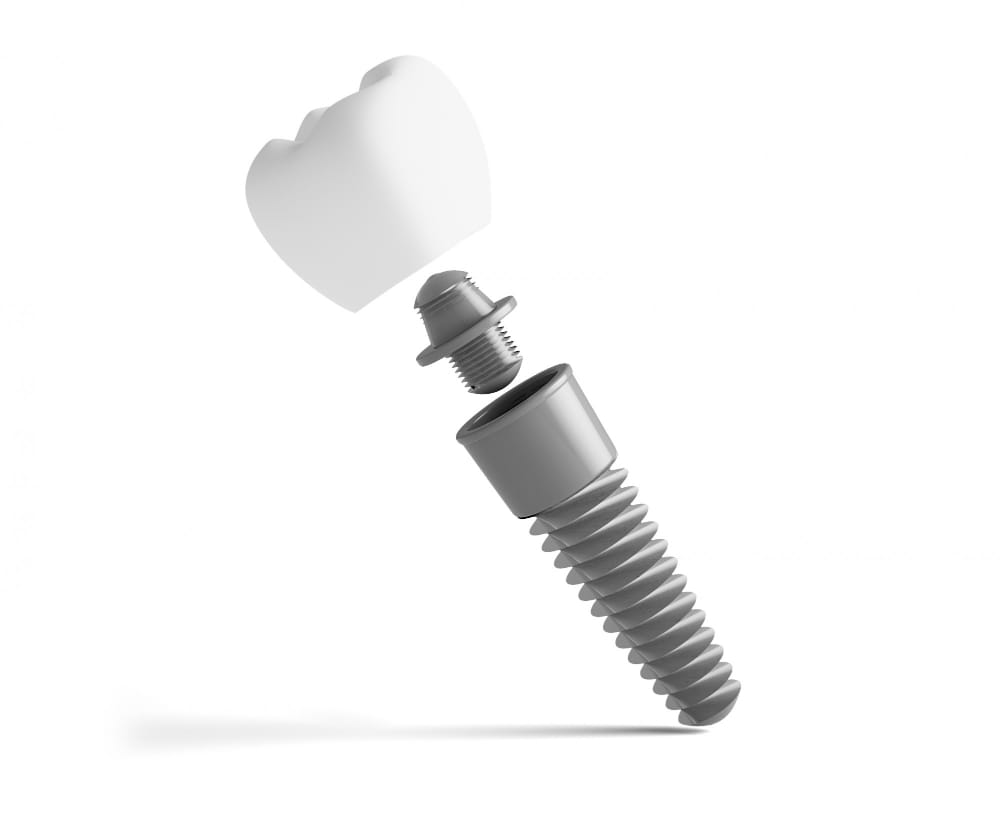 Implant zębowy