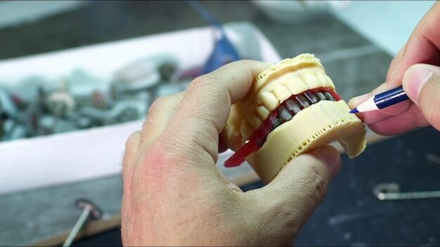 full mouth implant treatment