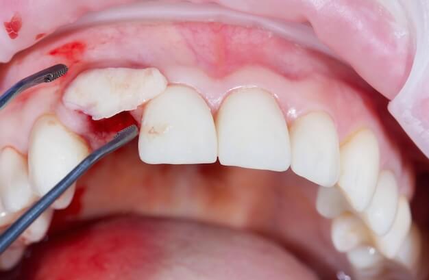 gingival graft surgery