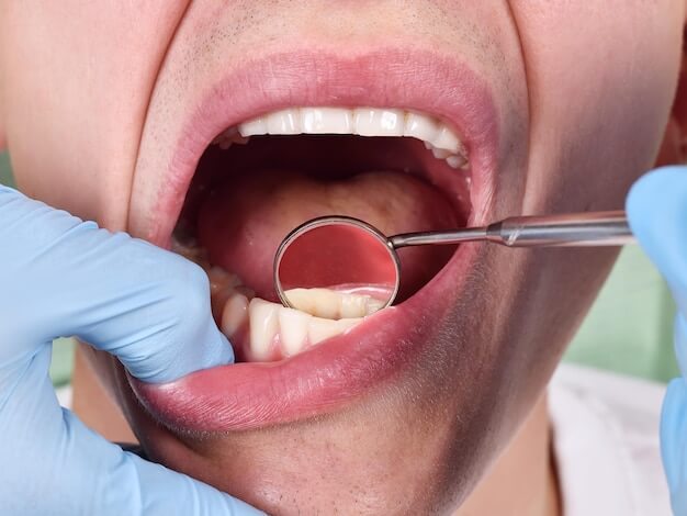 gingiwektomia