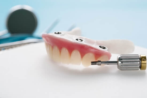 implant-supported bridge treatment