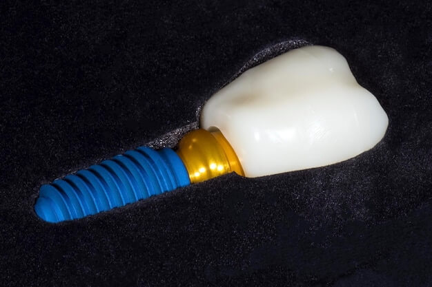 traitement de l’implant dentaire unitaire