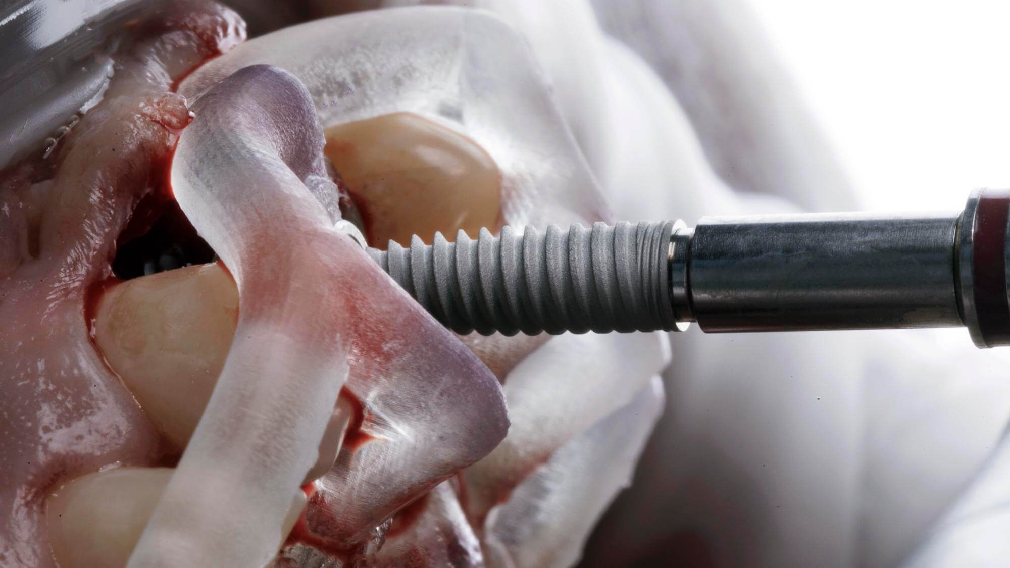 endosteal dental implants