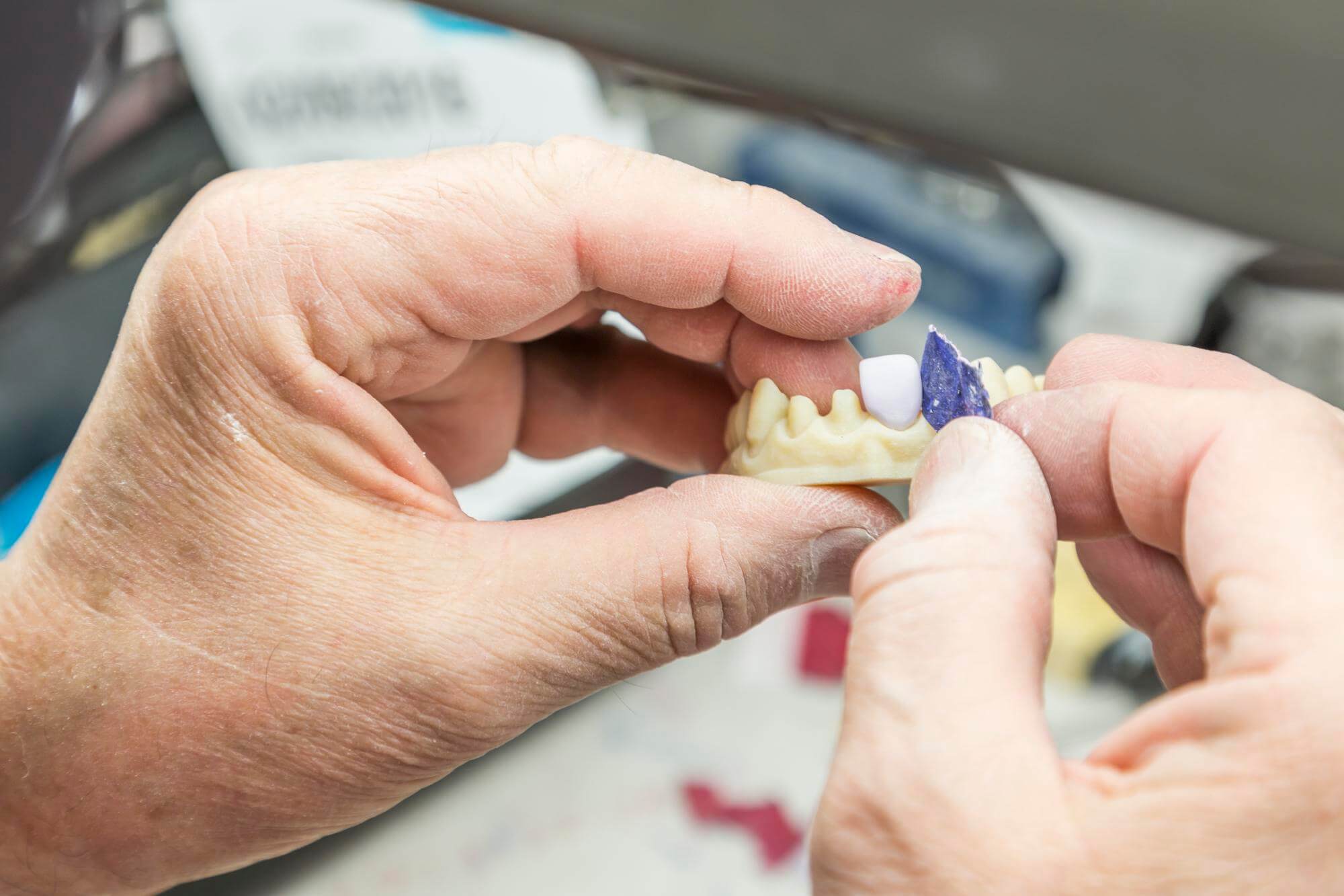 how do all-on-4 dental implants work